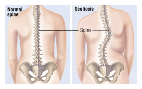 Normal-spine-and-scoliosis-2.jpg