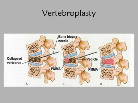 Tạo hình thân đốt sống bằng bơm xi măng sinh học không có bóng (vertebroplasty)