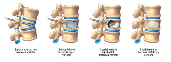 Tạo hình thân đốt sống bằng kỹ thuật bơm xi măng sinh học có bóng (Kyphoplasty)