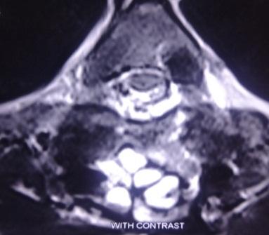 E:Spinecase studyABC in spineBN QuyềnDSC04896.JPG