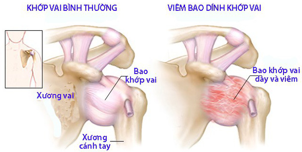 Viêm quanh khớp vai: Nguyên nhân, triệu chứng, chẩn đoán và điều trị |  Vinmec