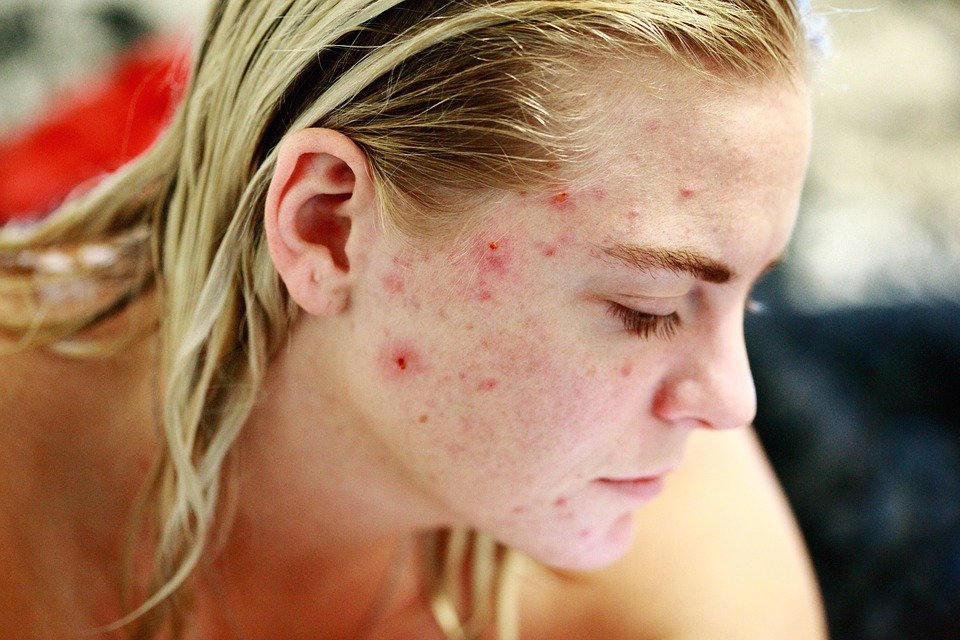 Struggle, Acne, Self Love, Skin, Face, Portrait, Woman