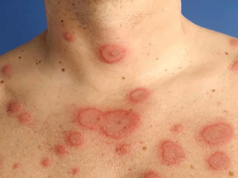 Bệnh lupus ban đỏ hệ thống giai đoạn cuối có nguy hiểm không? | Medlatec