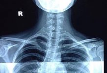 Chia sẻ ngắn về dự phòng vẹo cột sống