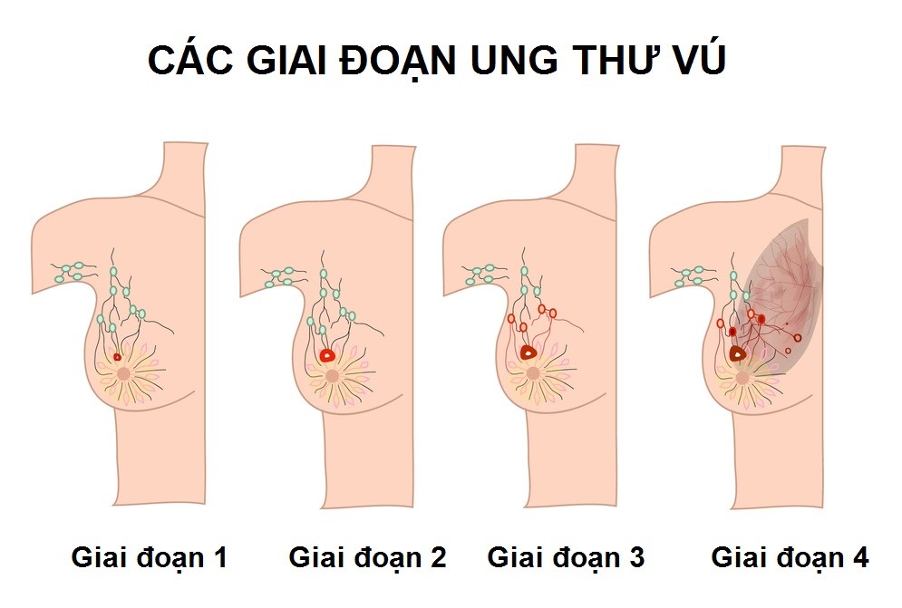 Tiên lượng sống của bệnh nhân ung thư vú từng giai đoạn - VnExpress Sức khỏe